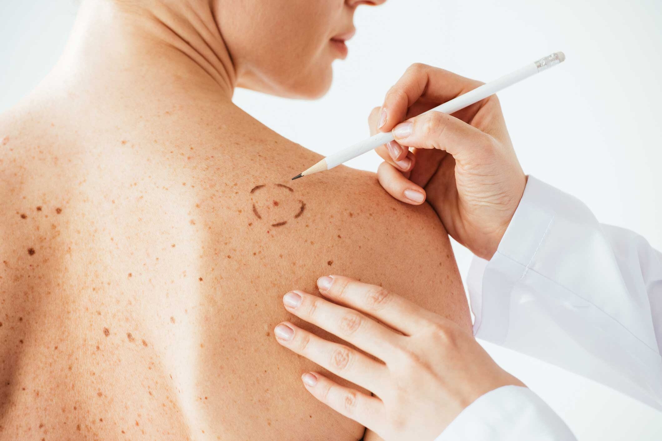 Woman receiving skin cancer assessment by doctor